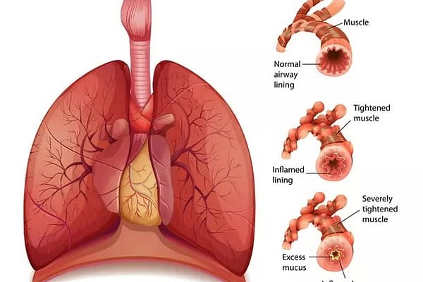 ఆస్తమా రాకుండా తీసుకోవాల్సిన జాగ్రత్తలు ఏంటి?